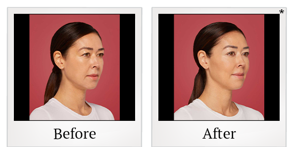 Before and After Photo 3 of Restylane® treatment at SF Bay Cosmetic Surgery Medical Group in San Ramon