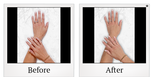 Before and After Photo 30 of Restylane® treatment at SF Bay Cosmetic Surgery Medical Group in San Ramon