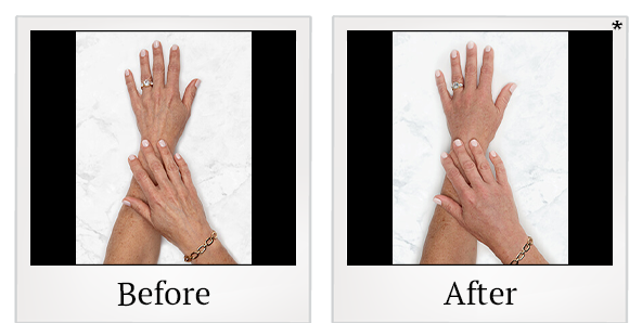 Before and After Photo 31 of Restylane® treatment at SF Bay Cosmetic Surgery Medical Group in San Ramon