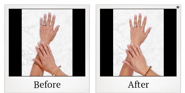 Before and After Photo 32 of Restylane® treatment at SF Bay Cosmetic Surgery Medical Group in San Ramon