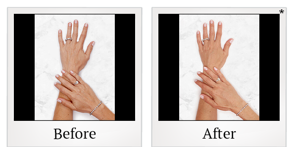 Before and After Photo 33 of Restylane® treatment at SF Bay Cosmetic Surgery Medical Group in San Ramon
