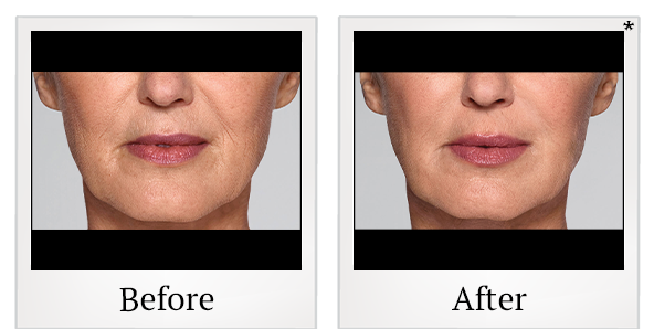 Before and After Photo 34 of Restylane® treatment at SF Bay Cosmetic Surgery Medical Group in San Ramon