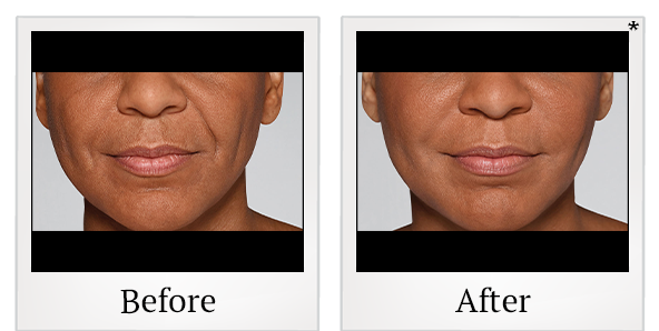 Before and After Photo 35 of Restylane® treatment at SF Bay Cosmetic Surgery Medical Group in San Ramon
