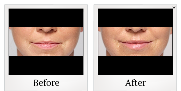 Before and After Photo 36 of Restylane® treatment at SF Bay Cosmetic Surgery Medical Group in San Ramon
