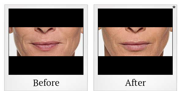 Before and After Photo 37 of Restylane® treatment at SF Bay Cosmetic Surgery Medical Group in San Ramon