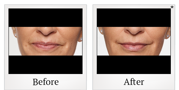 Before and After Photo 38 of Restylane® treatment at SF Bay Cosmetic Surgery Medical Group in San Ramon