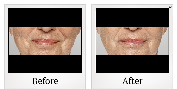 Before and After Photo 39 of Restylane® treatment at SF Bay Cosmetic Surgery Medical Group in San Ramon
