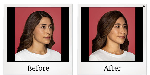 Before and After Photo 4 of Restylane® treatment at SF Bay Cosmetic Surgery Medical Group in San Ramon