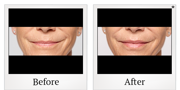 Before and After Photo 40 of Restylane® treatment at SF Bay Cosmetic Surgery Medical Group in San Ramon