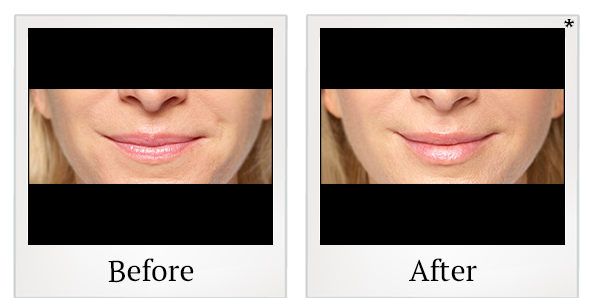 Before and After Photo 41 of Restylane® treatment at SF Bay Cosmetic Surgery Medical Group in San Ramon
