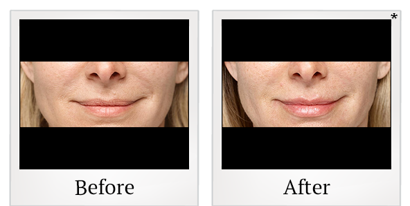 Before and After Photo 42 of Restylane® treatment at SF Bay Cosmetic Surgery Medical Group in San Ramon