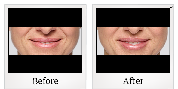 Before and After Photo 43 of Restylane® treatment at SF Bay Cosmetic Surgery Medical Group in San Ramon