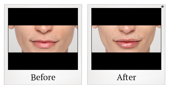 Before and After Photo 44 of Restylane® treatment at SF Bay Cosmetic Surgery Medical Group in San Ramon