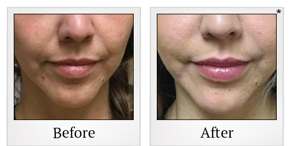 Before and After Photo 45 of Restylane® treatment at SF Bay Cosmetic Surgery Medical Group in San Ramon