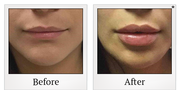 Before and After Photo 46 of Restylane® treatment at SF Bay Cosmetic Surgery Medical Group in San Ramon