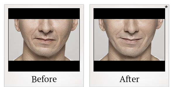 Before and After Photo 47 of Restylane® treatment at SF Bay Cosmetic Surgery Medical Group in San Ramon