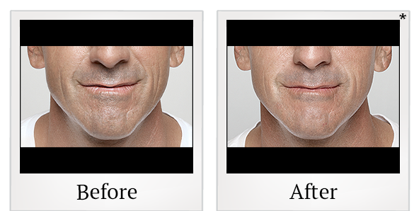 Before and After Photo 48 of Restylane® treatment at SF Bay Cosmetic Surgery Medical Group in San Ramon