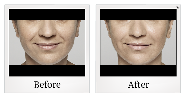 Before and After Photo 49 of Restylane® treatment at SF Bay Cosmetic Surgery Medical Group in San Ramon