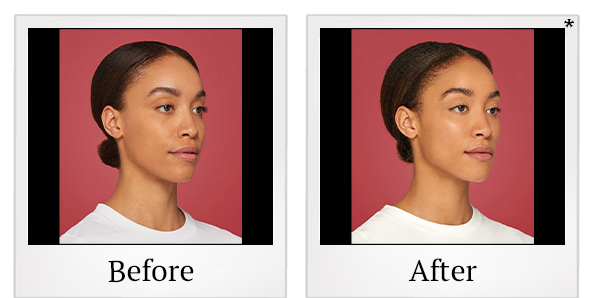 Before and After Photo 5 of Restylane® treatment at SF Bay Cosmetic Surgery Medical Group in San Ramon