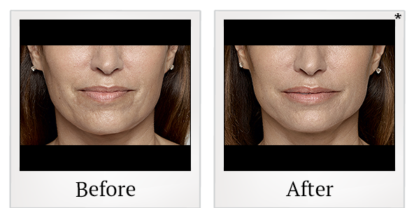 Before and After Photo 50 of Restylane® treatment at SF Bay Cosmetic Surgery Medical Group in San Ramon
