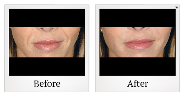 Before and After Photo 51 of Restylane® treatment at SF Bay Cosmetic Surgery Medical Group in San Ramon