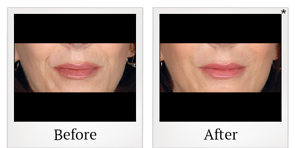 Before and After Photo 52 of Restylane® treatment at SF Bay Cosmetic Surgery Medical Group in San Ramon