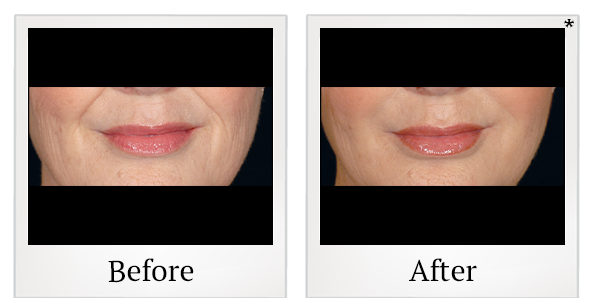 Before and After Photo 53 of Restylane® treatment at SF Bay Cosmetic Surgery Medical Group in San Ramon