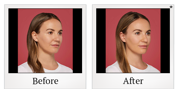 Before and After Photo 6 of Restylane® treatment at SF Bay Cosmetic Surgery Medical Group in San Ramon