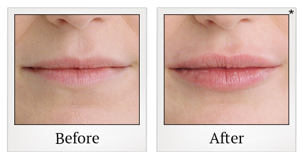Before and After Photo 7 of Restylane® treatment at SF Bay Cosmetic Surgery Medical Group in San Ramon