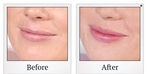 Before and After Photo 8 of Restylane® treatment at SF Bay Cosmetic Surgery Medical Group in San Ramon