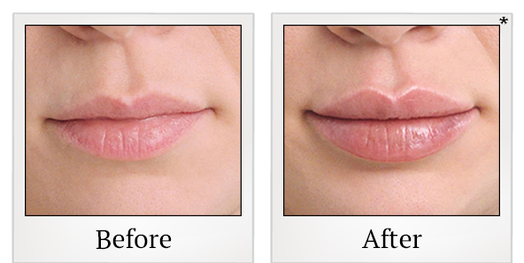 Before and After Photo 9 of Restylane® treatment at SF Bay Cosmetic Surgery Medical Group in San Ramon