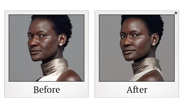 Before and After Photo 1 of RHA® Collection treatment at SF Bay Cosmetic Surgery Medical Group in San Ramon