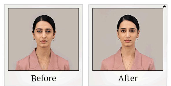 Before and After Photo 10 of RHA® Collection treatment at SF Bay Cosmetic Surgery Medical Group in San Ramon
