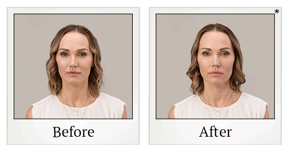 Before and After Photo 11 of RHA® Collection treatment at SF Bay Cosmetic Surgery Medical Group in San Ramon