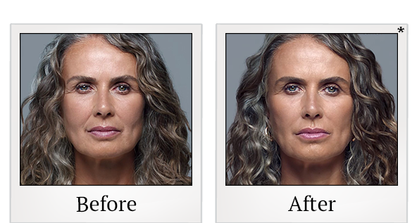 Before and After Photo 2 of RHA® Collection treatment at SF Bay Cosmetic Surgery Medical Group in San Ramon