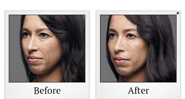 Before and After Photo 3 of RHA® Collection treatment at SF Bay Cosmetic Surgery Medical Group in San Ramon