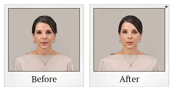 Before and After Photo 4 of RHA® Collection treatment at SF Bay Cosmetic Surgery Medical Group in San Ramon
