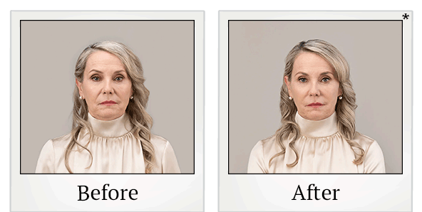 Before and After Photo 5 of RHA® Collection treatment at SF Bay Cosmetic Surgery Medical Group in San Ramon