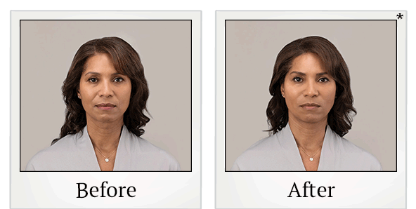 Before and After Photo 6 of RHA® Collection treatment at SF Bay Cosmetic Surgery Medical Group in San Ramon