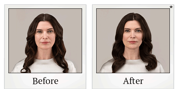 Before and After Photo 7 of RHA® Collection treatment at SF Bay Cosmetic Surgery Medical Group in San Ramon