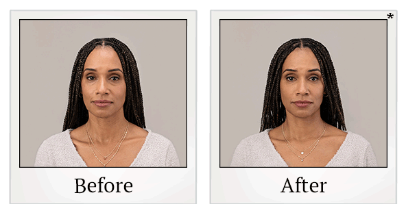 Before and After Photo 8 of RHA® Collection treatment at SF Bay Cosmetic Surgery Medical Group in San Ramon