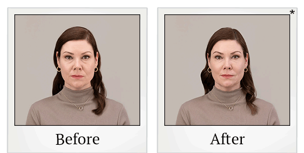 Before and After Photo 9 of RHA® Collection treatment at SF Bay Cosmetic Surgery Medical Group in San Ramon