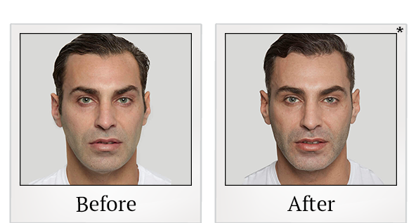 Before and After Photo 1 of Sculptra® treatment at SF Bay Cosmetic Surgery Medical Group in San Ramon