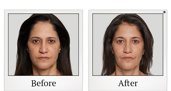 Before and After Photo 10 of Sculptra® treatment at SF Bay Cosmetic Surgery Medical Group in San Ramon