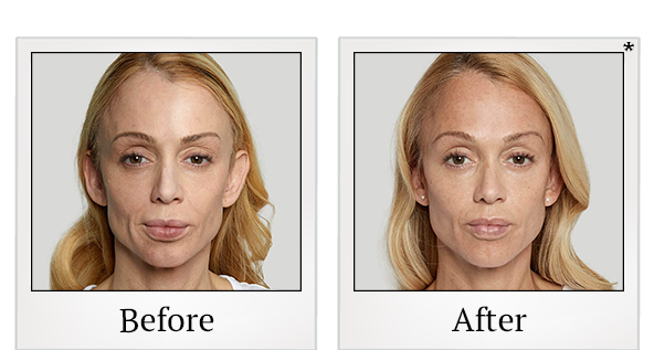 Before and After Photo 2 of Sculptra® treatment at SF Bay Cosmetic Surgery Medical Group in San Ramon