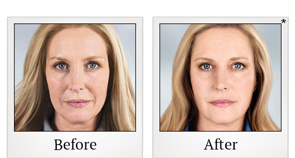 Before and After Photo 3 of Sculptra® treatment at SF Bay Cosmetic Surgery Medical Group in San Ramon