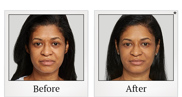 Before and After Photo 4 of Sculptra® treatment at SF Bay Cosmetic Surgery Medical Group in San Ramon