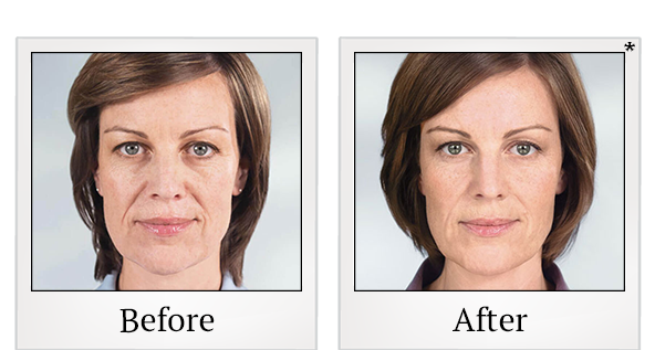 Before and After Photo 5 of Sculptra® treatment at SF Bay Cosmetic Surgery Medical Group in San Ramon