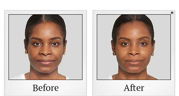 Before and After Photo 6 of Sculptra® treatment at SF Bay Cosmetic Surgery Medical Group in San Ramon