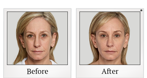 Before and After Photo 7 of Sculptra® treatment at SF Bay Cosmetic Surgery Medical Group in San Ramon